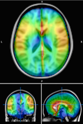 Image of 3 brain scans 